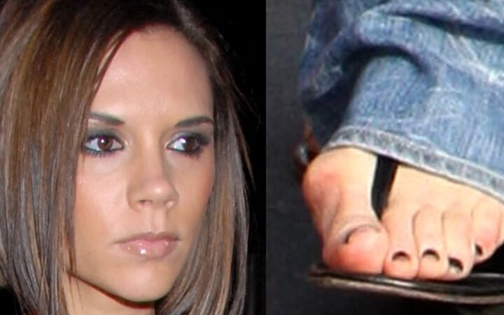 Victoria Beckham Bunions Surgery: What Happened and Why It Matters